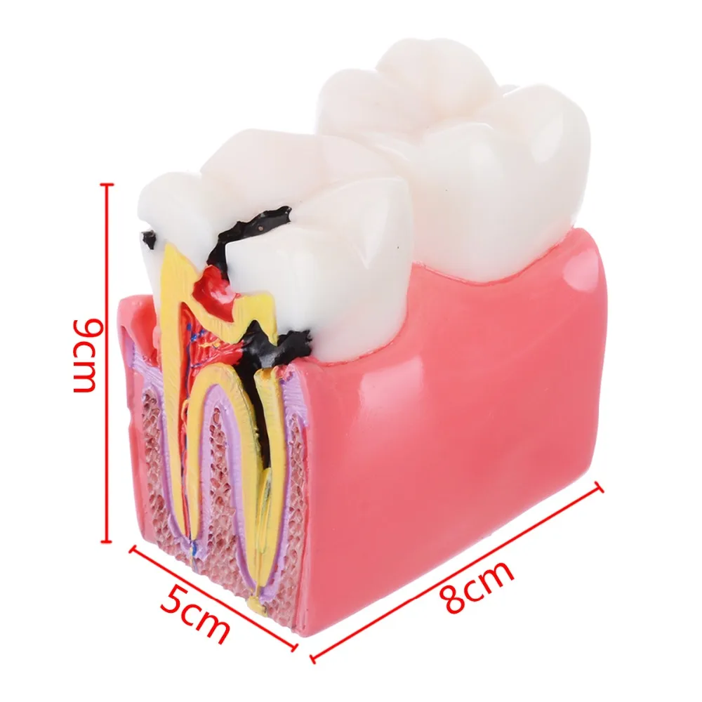 Beste 1pc Dental Anatomie Onderwijs Tanden Model 6 Keer Cariës Comparation Studie Modellen Voor Tandarts Studeren en Onderzoek