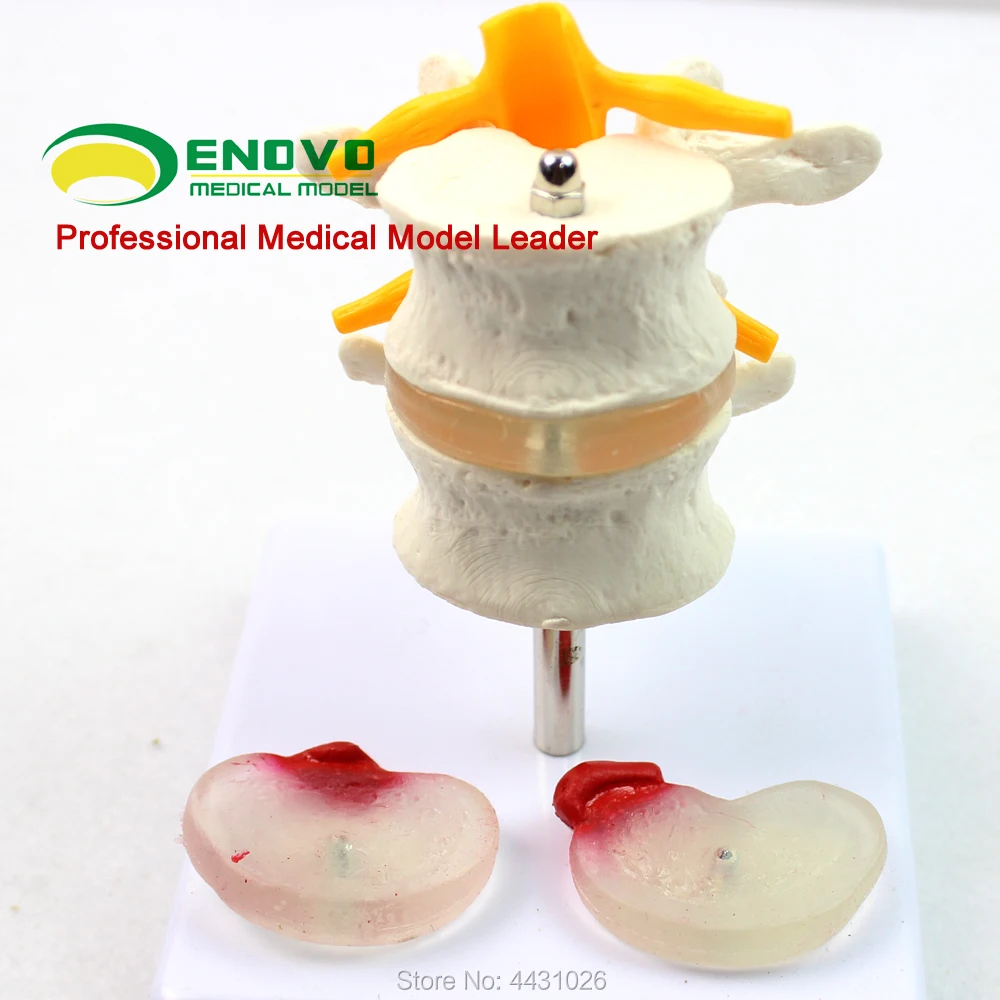 ENOVO The human lumbar model of vertebral disc herniation model of bone spinal vertebrae ENOVO The human lumbar model of vertebral disc herniation model of bone spinal vertebrae