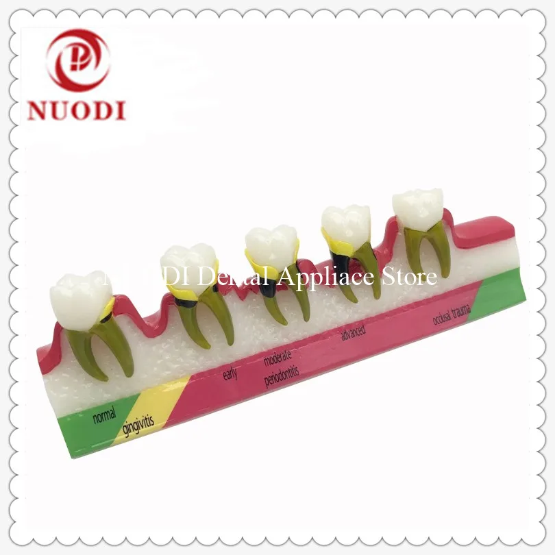 

Dental Tooth Model show 5 Stage Dentist Odontologia Periodontal Disease Dental Teeth Model/Doctor-Patient Communication Model
