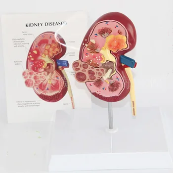 

Kidney disease model urology kidney nephron glomerular kidney model renal anatomy model