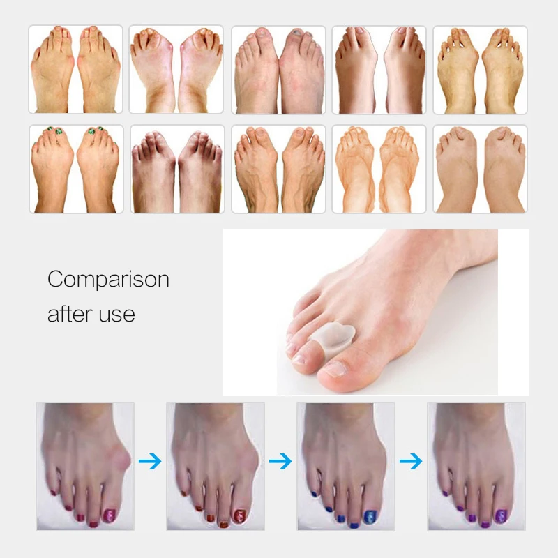 1Pair Braces Foot Care Toe Braces Silicone Toe Separator Hallux Valgus Orthopedic Corrector Pedicure Tools Health Care Products
