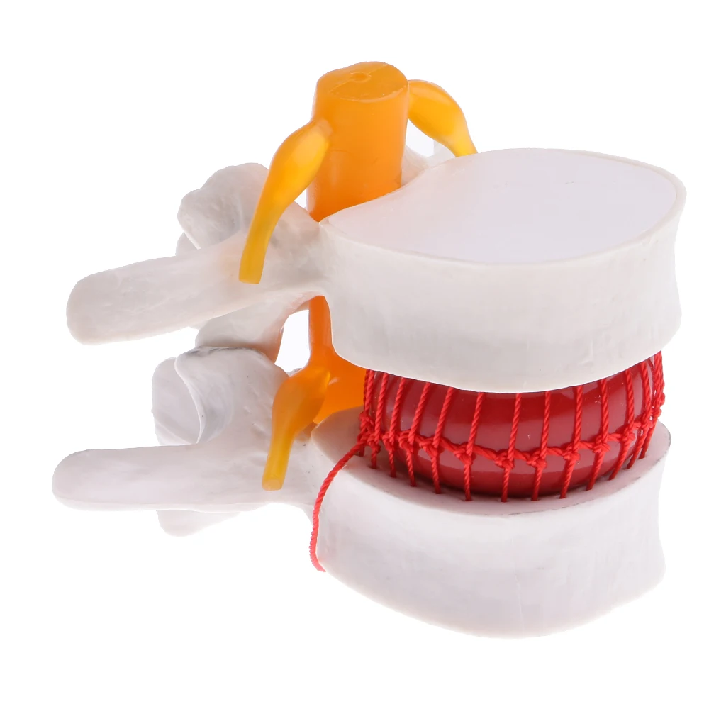  Anatomical Human Lumbar Vertebrae Degenerative Disc Model  Lab Demonstration Supplies  Medical Teac - 33036948097