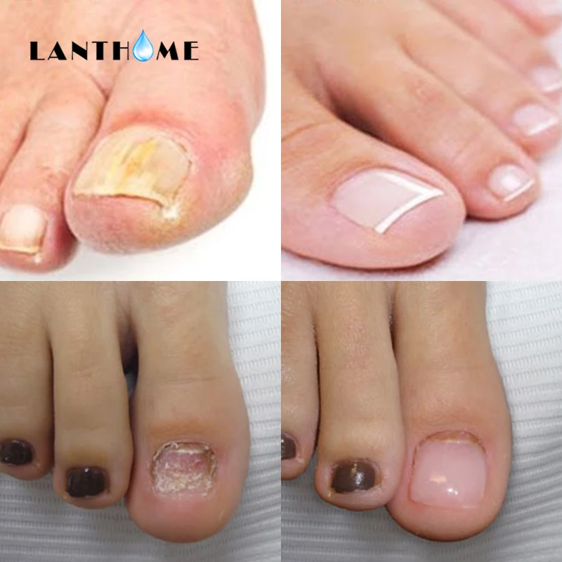 The Herb Nail Nutrition Oil Pen Cuticle Revitalizer Oil Nail Care Nourish Skin Fungus Nail Toe Treatment Anti Fungal Infection