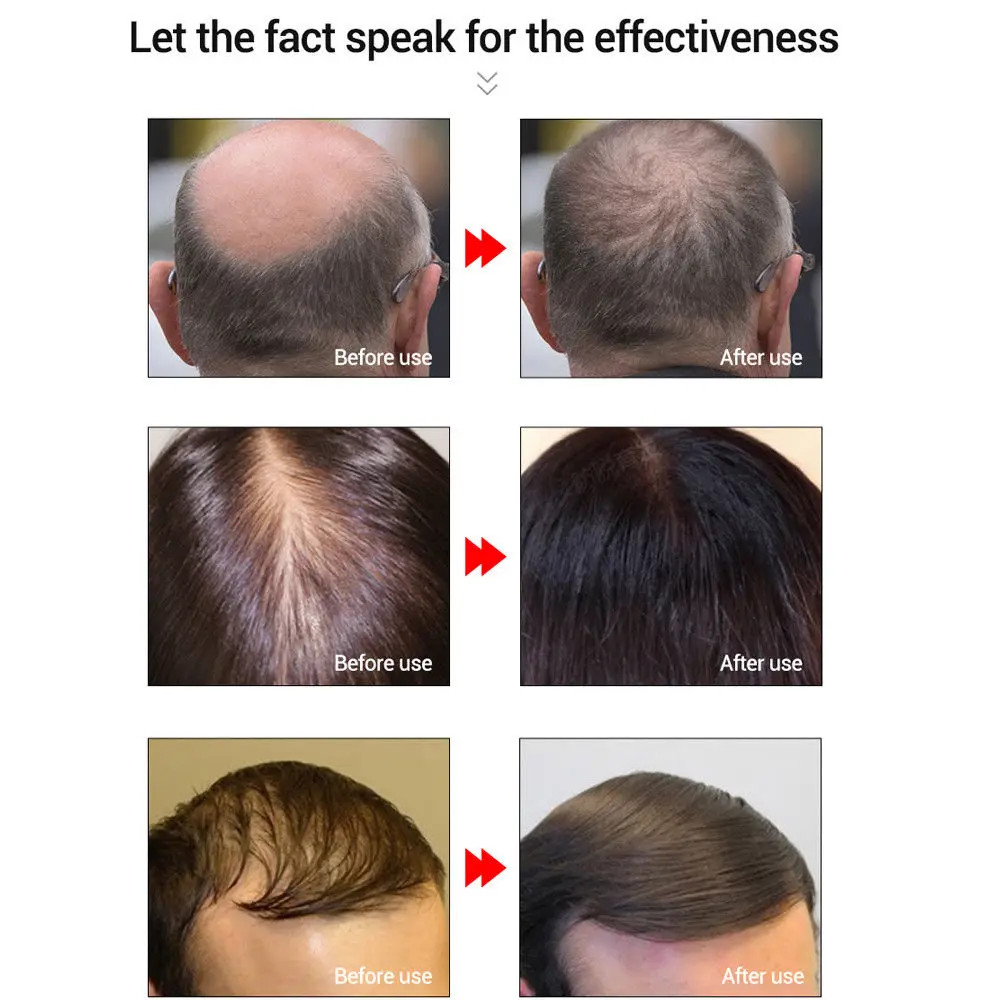 Средство для роста волос, предотвращающее облысение, укрепляющее от выпадения волос натуральные питающие корни легко переносят Уход за волосами TSLM1