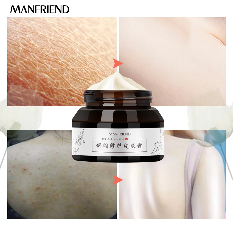 Repair Body Skin Cream Relieve Hair Follicle Plugged Anti-Chapping Antibacterial Moisturizing Nourishing Body Cream Skin Care Repair Body Skin Cream Relieve Hair Follicle Plugged Anti-Chapping Antibacterial Moisturizing Nourishing Body Cream Skin Care