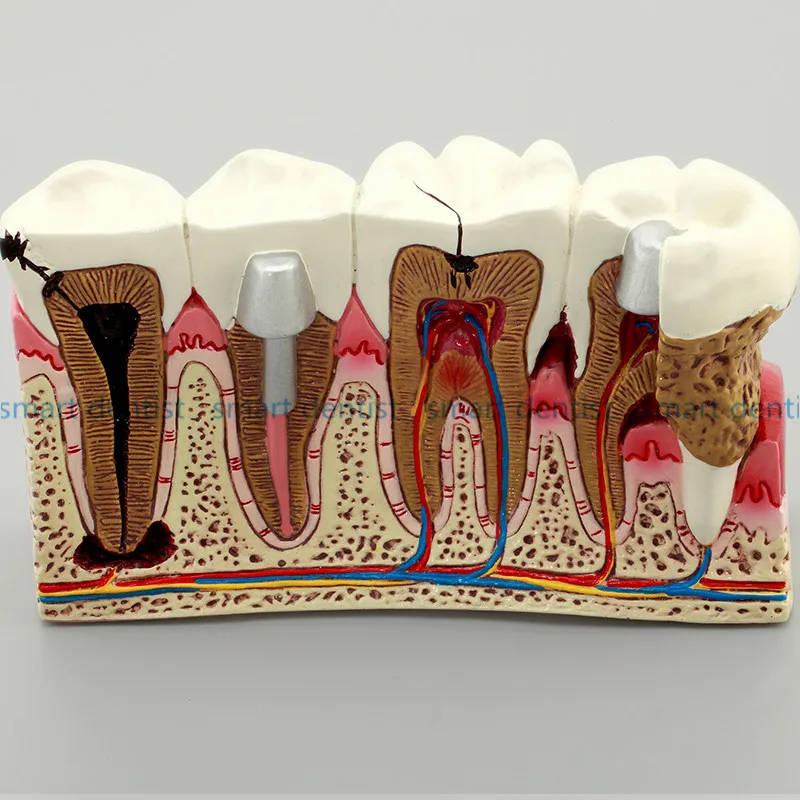Хорошее качество кариес Зуб модель стоматолога пациента связь Анатомия Модель Стоматология Богатые детали обучающие средства оборудования