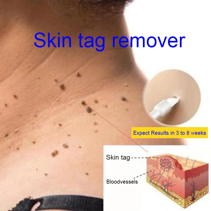 

2018 6ml/Bottle Dropshipping Skin Tag Remover 12 hours Medical Tu kill Remover Skin Tag Mole & Genital Wart Remover