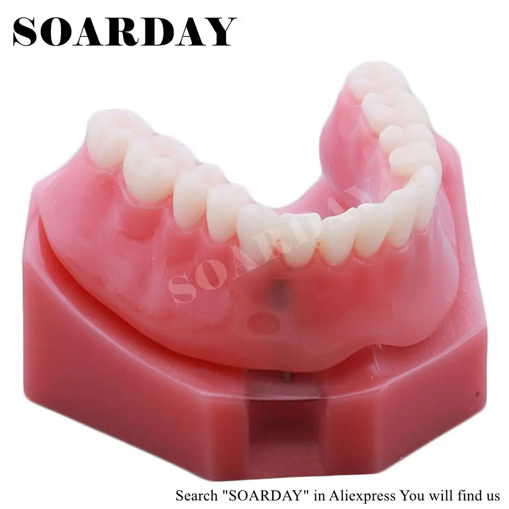 SOARDAY Overdenture уступает с 2 имплантами зубной зуб зубы стоматолог стоматология анатомическая Стоматологическая модель