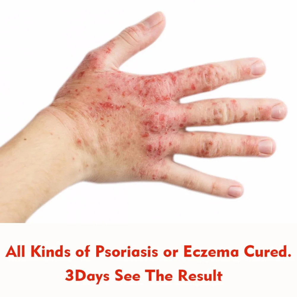 Strong Effect Massage Cream Psoriasis Dermatitis Eczema Treatment