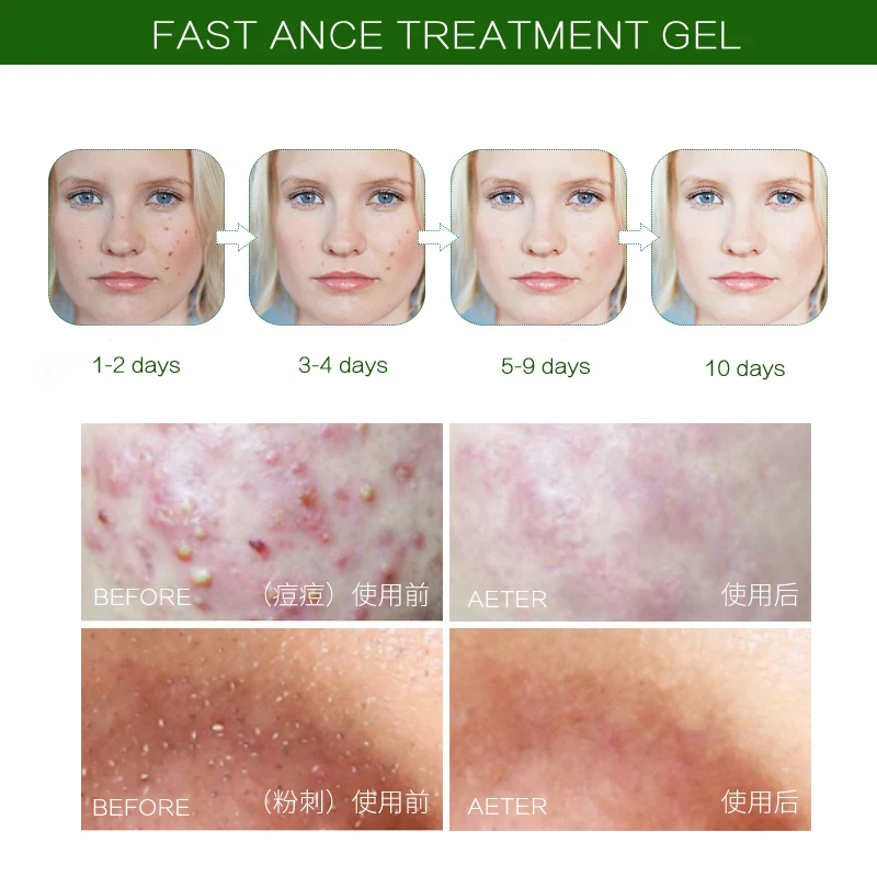 Óleo da Árvore do Chá Seca a Pele do Problema Gel para o Tratamento de Espinhas Austrália Quinta Medicado Cravos Espinhas Acne Propensas Pele 6 Pcs 13 Bronzeadores artificiais