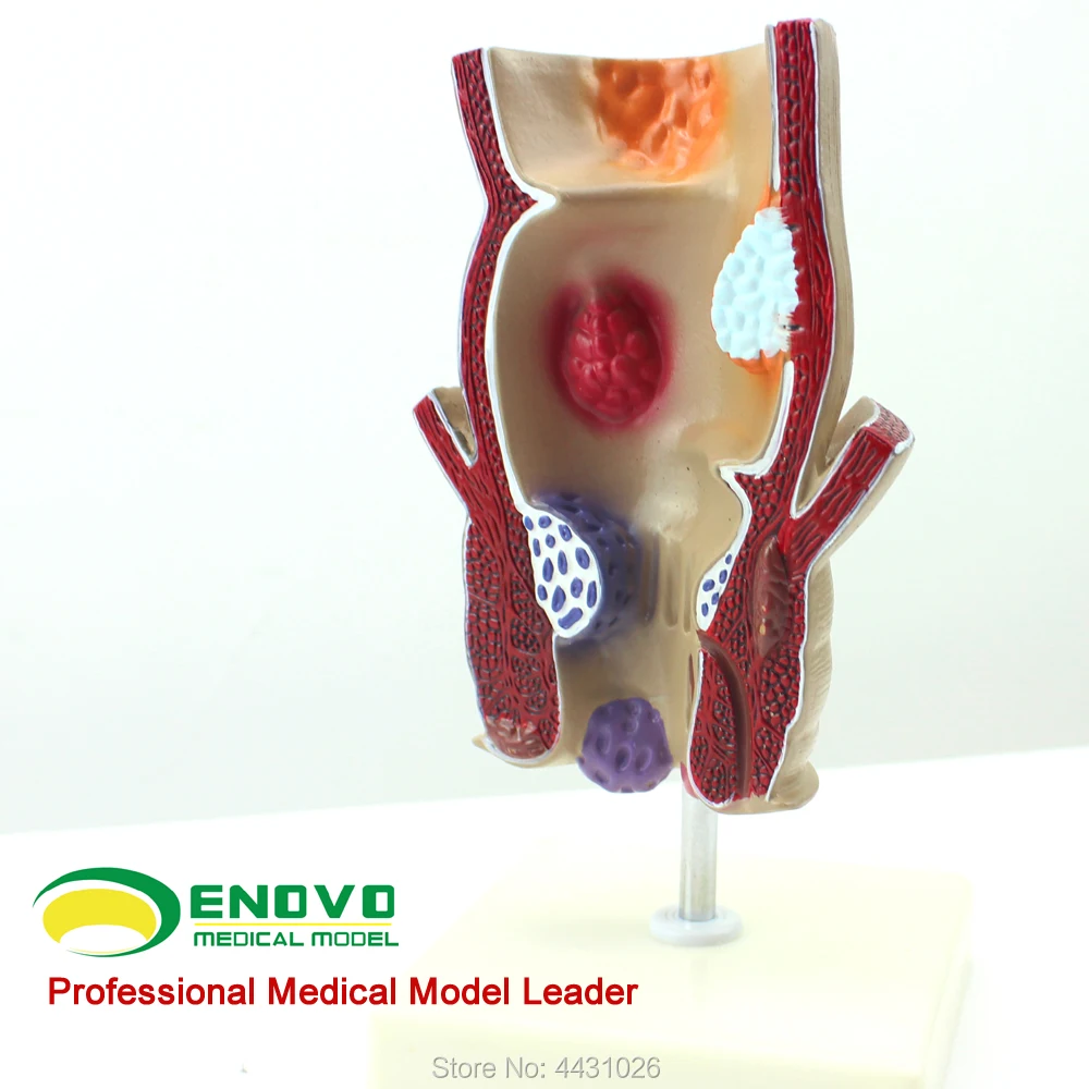 ENOVO The pathological model of human anorectal pathology is a model of the disease model of anal fistula цена ENOVO The pathological model of human anorectal pathology is a model of the disease model of anal fistula цены онлайн