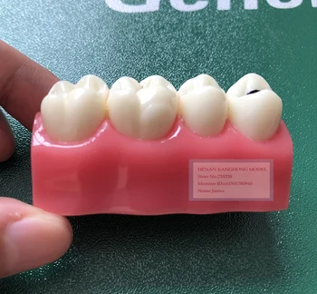

Pit and Fissure Closure Model,Early Dental Caries Model