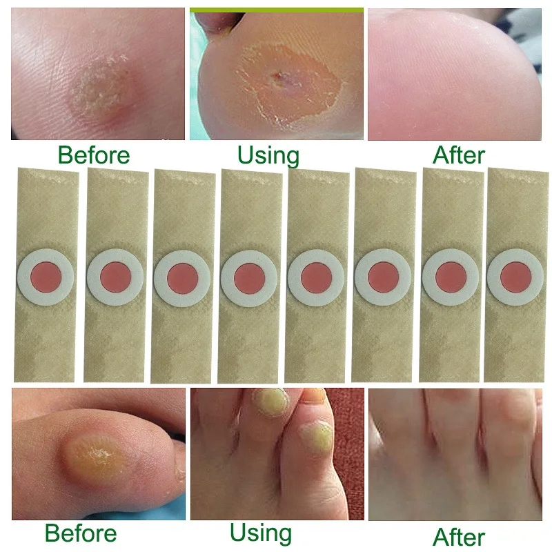 

40pcs Foot Corn Killer Calluses Plantar Warts Thorn Pain Relief Plaster Foot Care Tool Medical Sticker Toe Protector