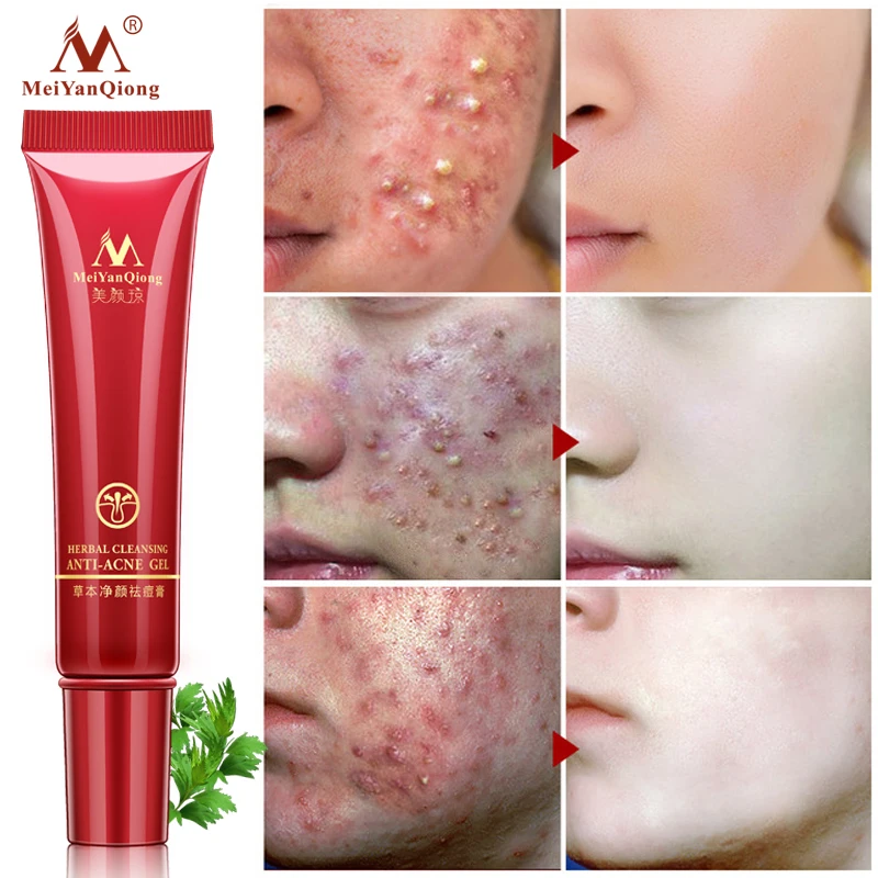 

Meiyanqiong Face Cream Herbal Cleansing Face Anti acne treatment cream Herbal scar removal oily skin Acne Spots skin care face