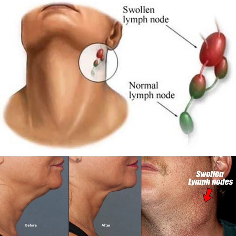 Воспаление лимфатические узлы шеи причины. Лимфоузлы долго. Схема подчелюстных лимфоузлов. Стью. Шейный лимфаденит клиника.