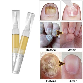 

3ml Nail Fungus Treatment Pen Anti Fungal Nail Treatment Fungus Stop Infection Repair Solution Gel Fingernails Toenails Care