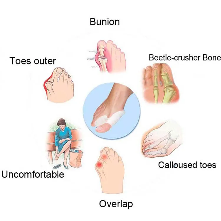 1 пара Силиконовый гель Bunion сепаратор для большого пальца ноги Рассекатель Облегчает боль в ногах исправление шишки на ноге Защитная