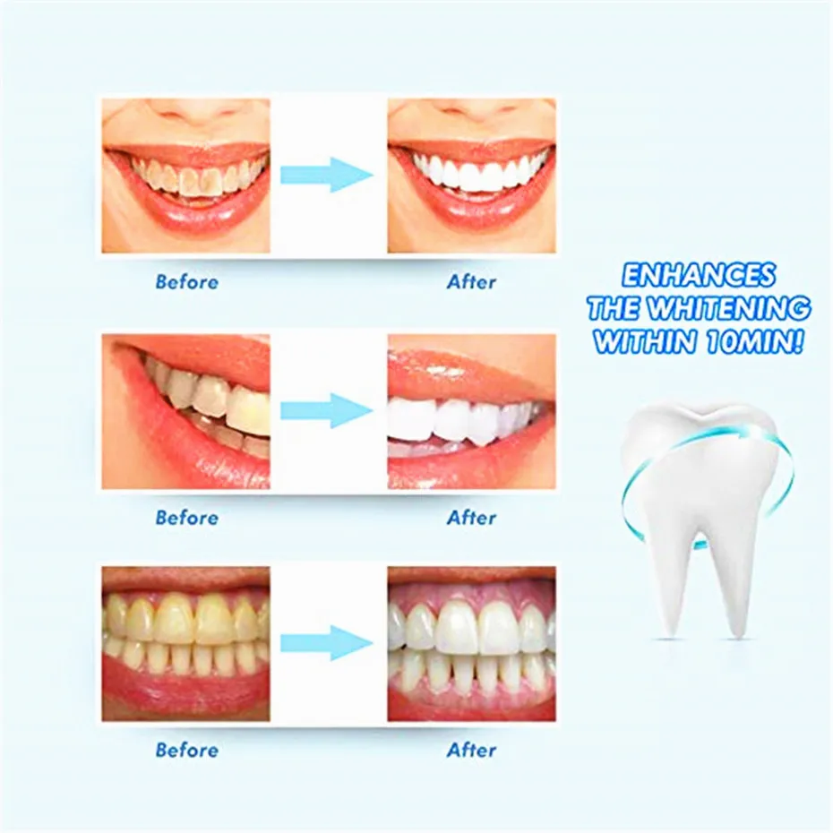 Ускоритель для отбеливания зубов, синий светодиодный индикатор для более быстрого отбеливания зубов, гель или отбеливатель не входят в комплект