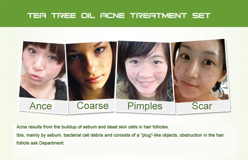 Óleo da Árvore do Chá Seca a Pele do Problema Gel para o Tratamento de Espinhas Austrália Quinta Medicado Cravos Espinhas Acne Propensas Pele 6 Pcs 12 Cheap Bronzeadores artificiais