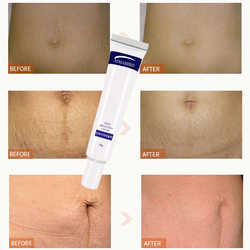spesifikasi 3 Buah Banyak Shea Butter Menghapus Kehamilan Bekas Luka Krim Maternity Jerawat Krim Stretch Mark Remover Grossesse Anti Winkles Firming Tubuh