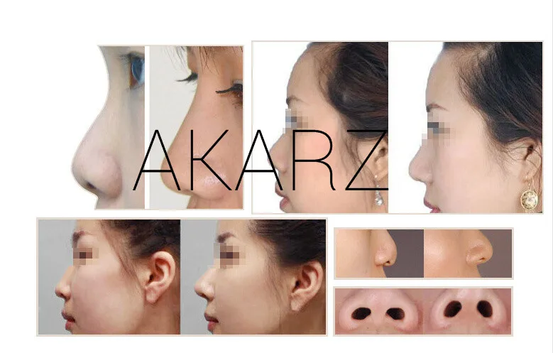 Знаменитый бренд AKARZ No Surgery мощное нозальное масло для ремоделирования крем