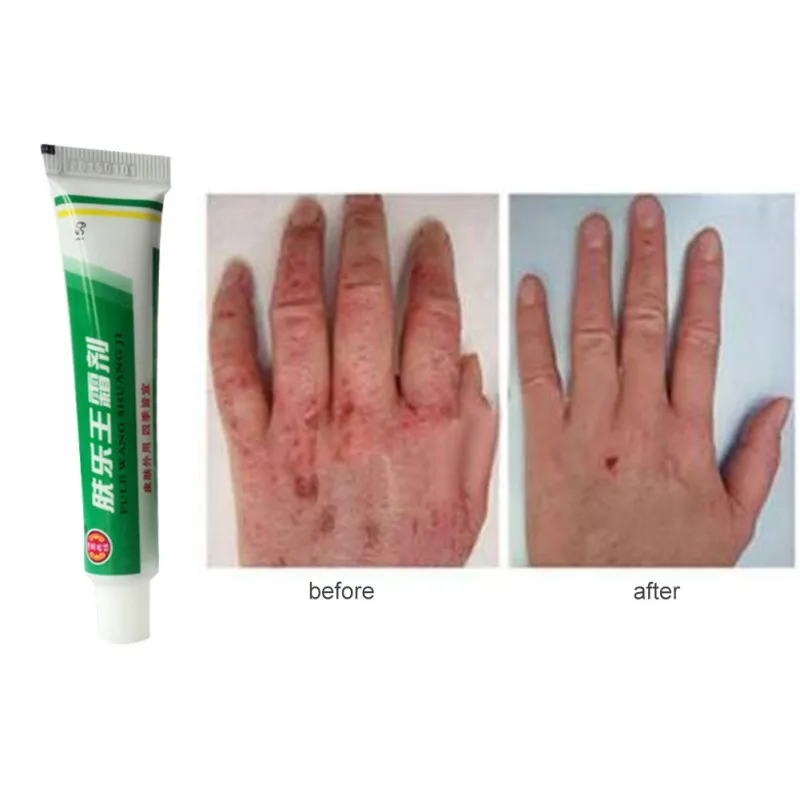Skin cream Chinese herbal skin topical antipruritic ointment cream Analgesic Balm Ointment Psoriasis Cream Body Massage Patches Skin cream Chinese herbal skin topical antipruritic ointment cream Analgesic Balm Ointment Psoriasis Cream Body Massage Patches