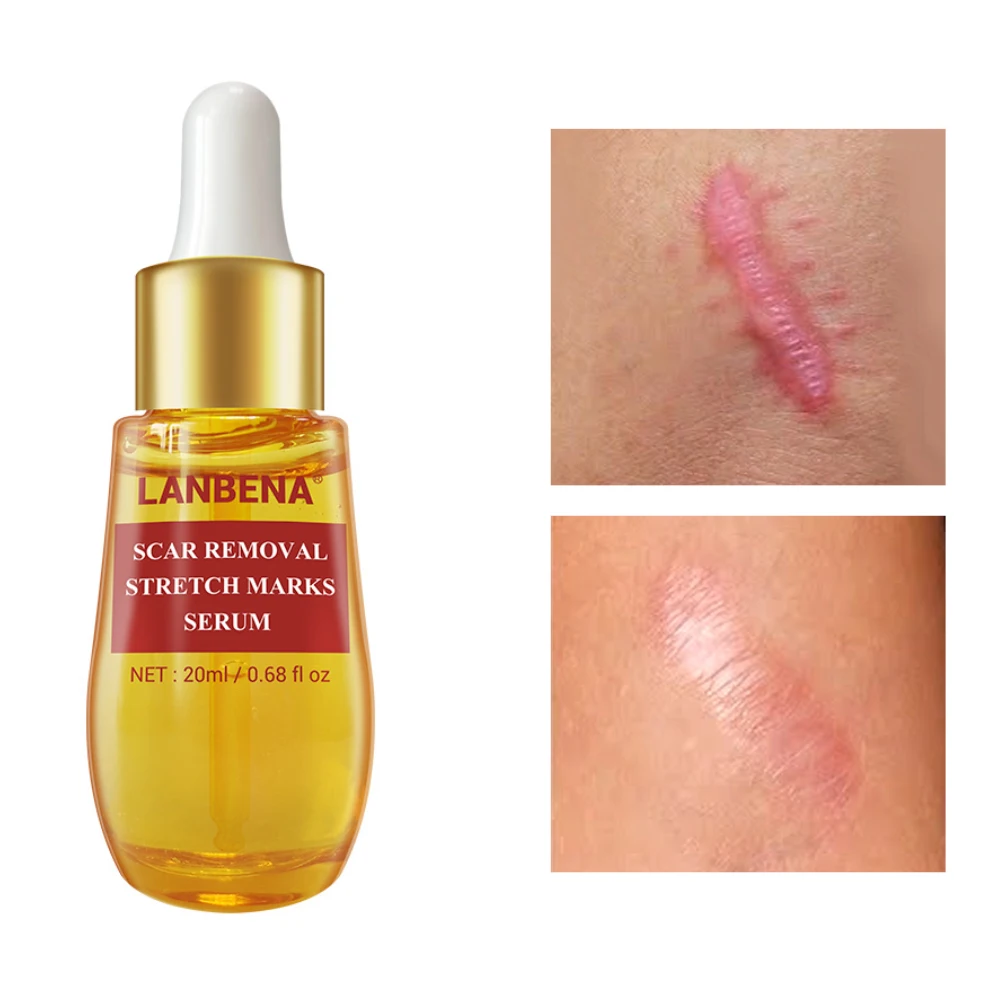 

Scar Removal Serum Stretch Marks Skin Repair Maternity Scar Removal Essential Oil Acne Treatment Moisturizing Facial Skin Care