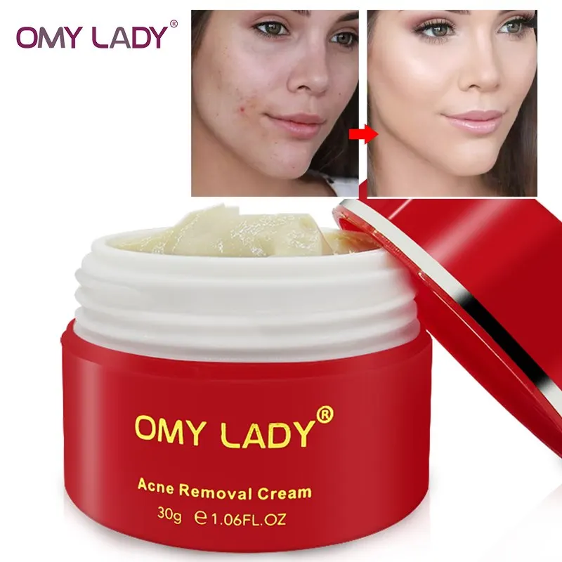 

OMYLADY Powerful Multi Effect extract Cream Eliminates wrinkles Remove Acne Scar treatment acne Anti aging Face Care gel