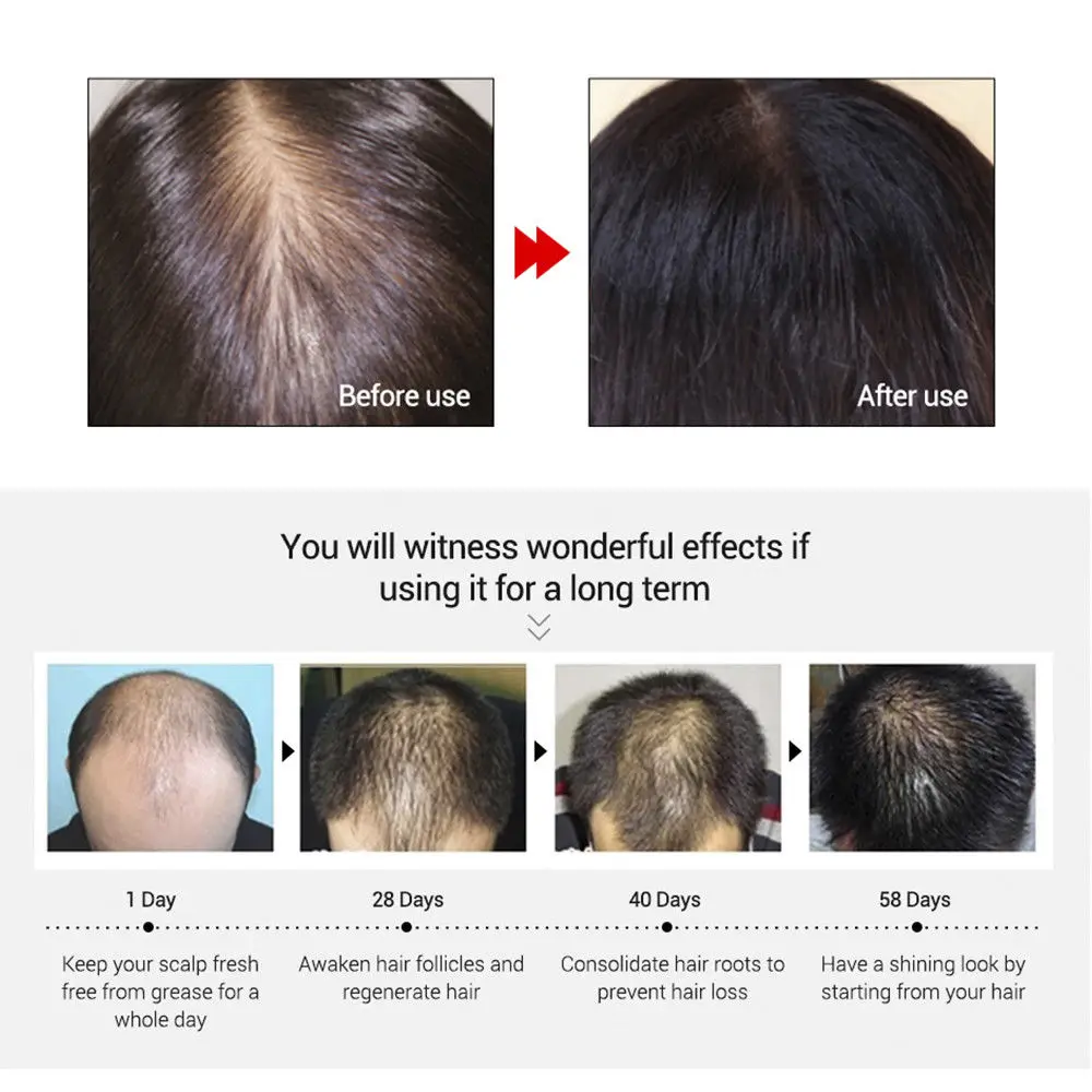 Средство для роста волос, предотвращающее облысение, укрепляющее от выпадения волос натуральные питающие корни легко переносят Уход за волосами TSLM1