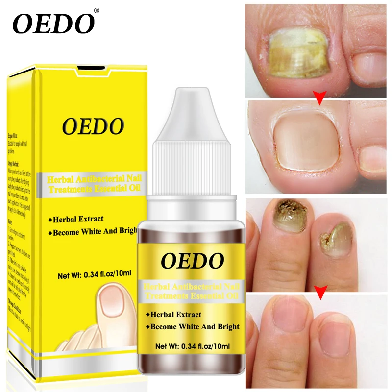 

Herbal Antibacterial Nail Treatments Essential Oil Herbal Extract Nail Fungus Art Repair Tools Foot Nail Care Improve Infection