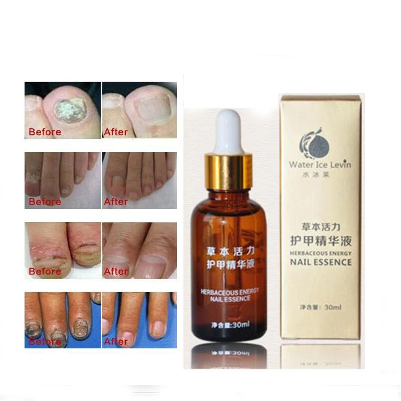 Buy Fungal Nail Treatment Essence Nail and Foot