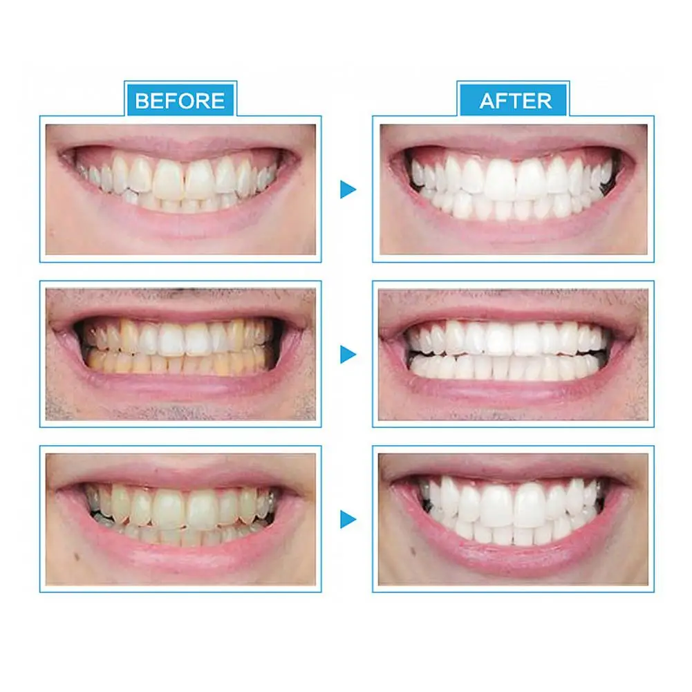 XY фантазии 6 V Белый светодиодный свет отбеливание зубов отбеливающий гель для зубов забота о здоровье полости рта