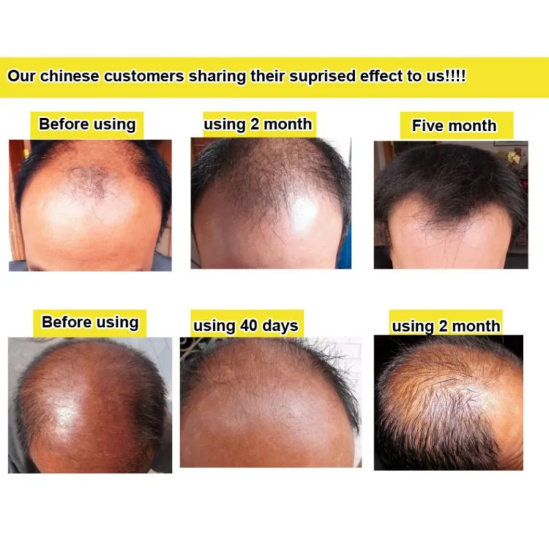 Эссенция для быстрого роста волос жидкость 20 м продукты против седых волос Спрей Шампунь сыворотка лечение выпадения волос уход за волосами продукт
