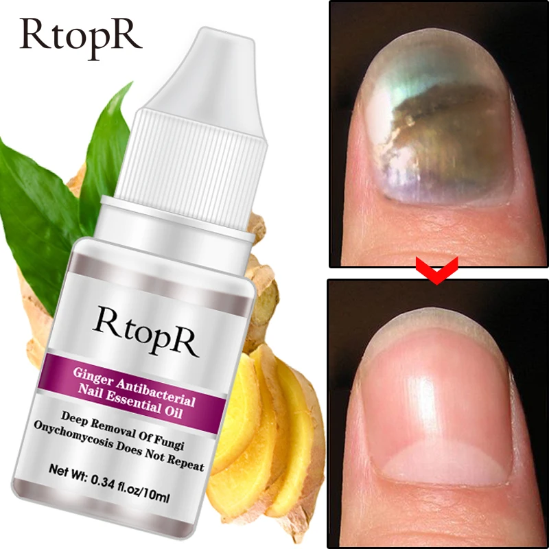 

10ml Fungal Nail Treatment Essence Onychomycosis Paronychia Anti Fungal Remove Onychomycosis Toe Nail Nourishing Hand Care TSLM2