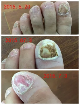 

toe nail fungus Gray nail special traditional Chinese Natural nail fungus treatment fungus nails fungal nail treatment care