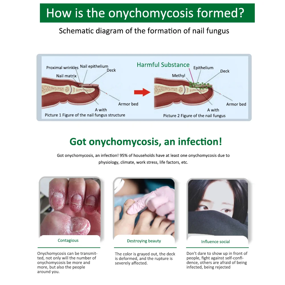 1 упаковка для ремонта ногтей эссенция сыворотка грибковый Уход за ногтями лечение удаление онихомикоза рук и ног уход за носками питательный блеск