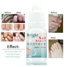1 шт. лечение грибковых ногтей Уход за ногтями для рук и ног эссенция отбеливание ногтей и ног удаление грибка Полезная Прямая поставка