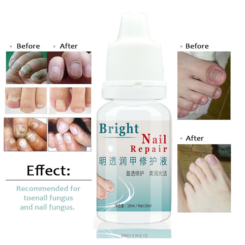 

1PC Fungal Nail Treatment Feet Hand Nail Care Essence Nail and Foot Whitening Toe Nails Fungus Removal Useful Drop Shipping