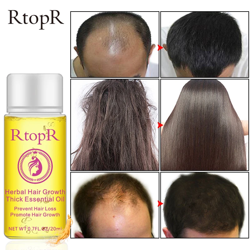 

RtopR Fast Powerful Hair Growth Essence Products Essential Oil Liquid Treatment Preventing Hair Loss Hair Care Andrea 20ml