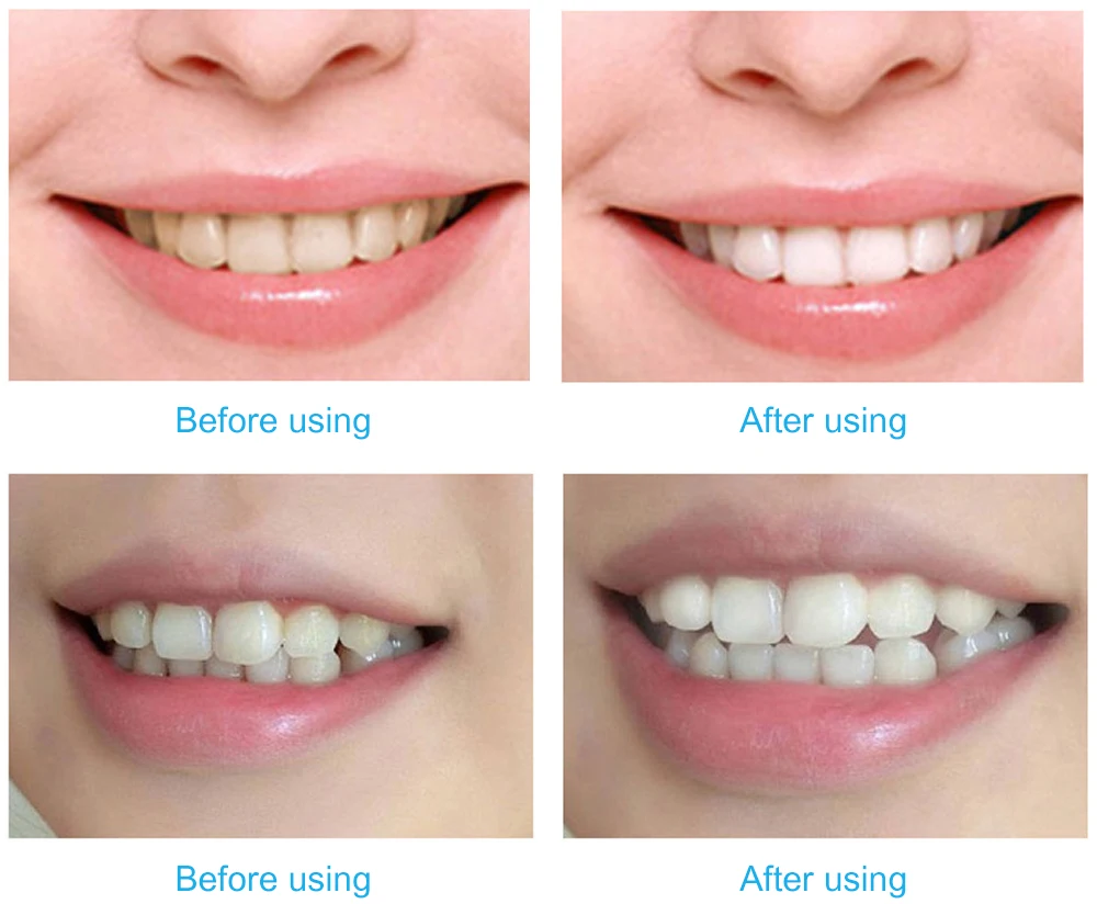 Отбеливатель зубов белый свет с 2 шт. Отбеливающие гели и батарея Повседневная жизнь отбеливание зубов использование