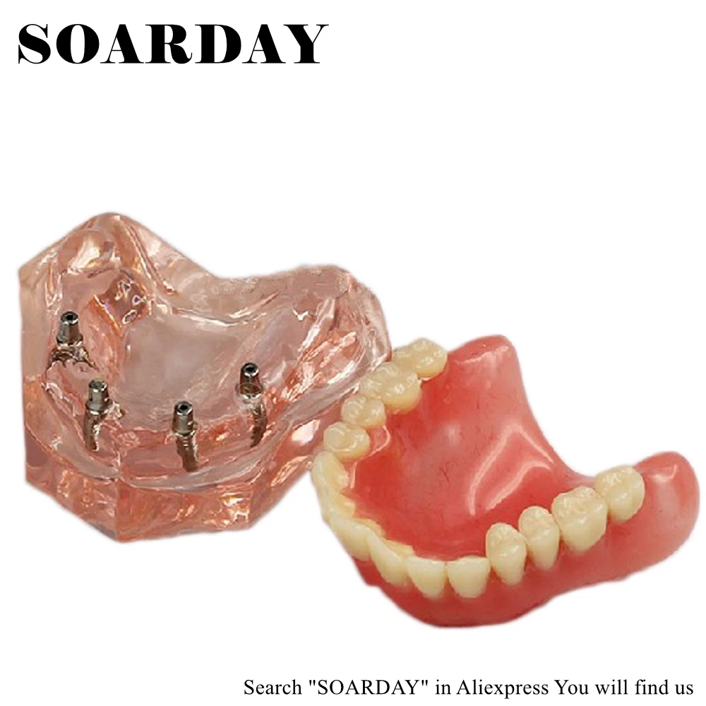 SOARDAY Overdenture низкого качества с 4 импланты с шероховатой поверхностью стоматологический для обучения зуб зубы стоматолог стоматология зубные полоски