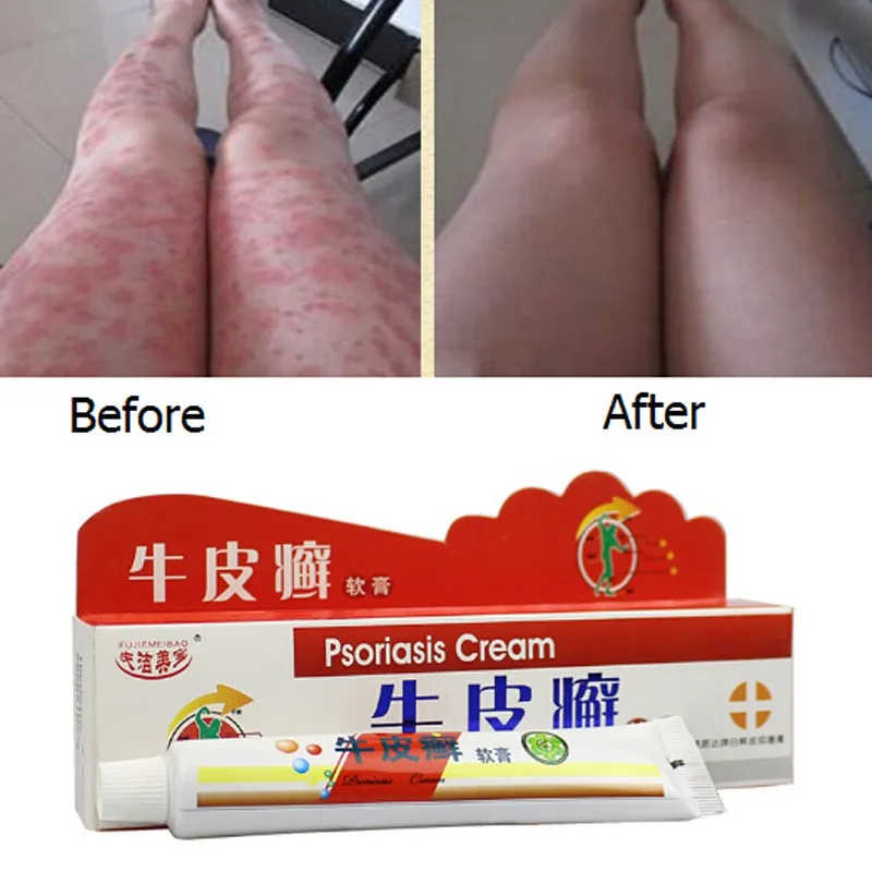 

25g Psoriasis Cream Chinese Ointment Chinese Medicine