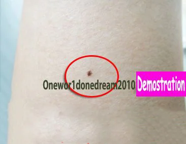 Эффект здоровья натуральный крот Nevus Wart метка на коже удаление Настоящее кожи Demo++ действительно работает