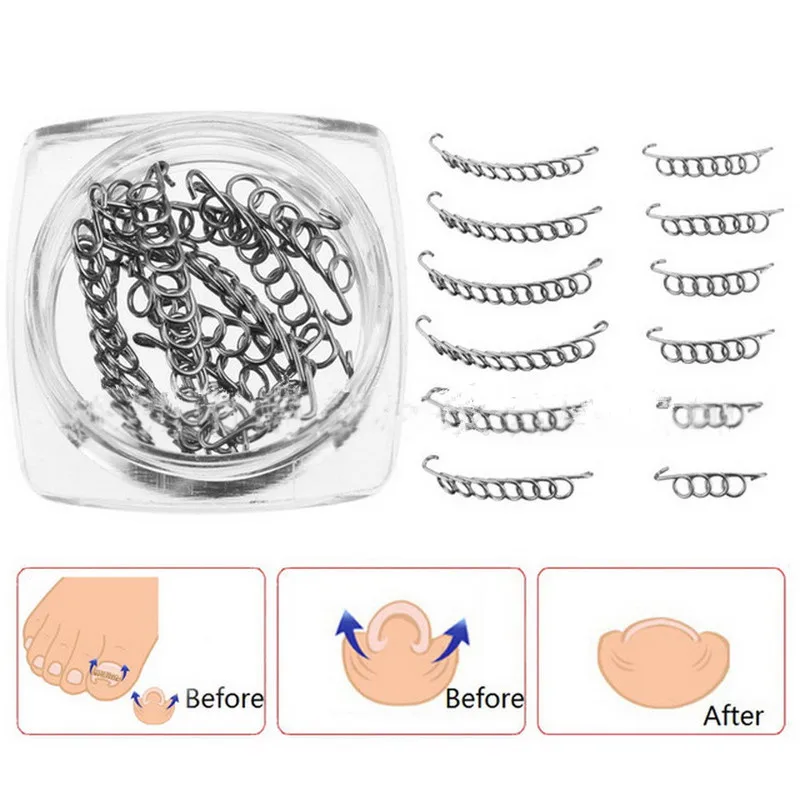

12pcs Ingrown Toe Nail Correction Wire Fixer Pedicure Paronychia Recover Toenails Corrector Foot Care Tool