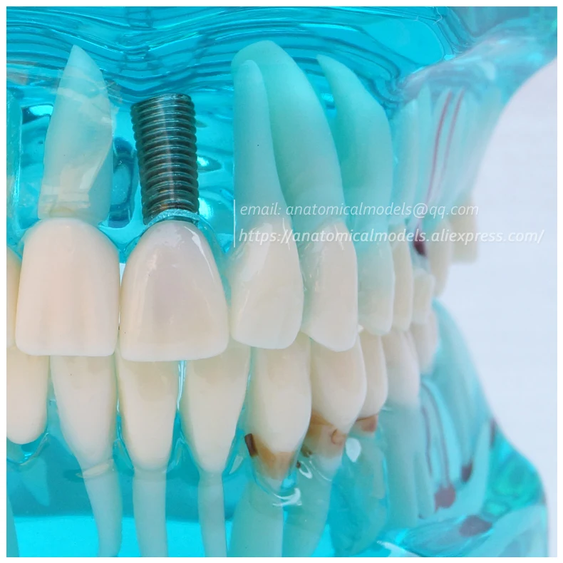 13069 Restoration with Implant 2 