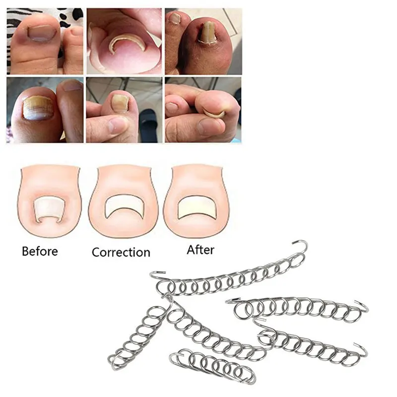 12 шт./компл. вросший носок проволочный фиксатор для коррекции ногтей Педикюр Paronychia восстановление ногтей Корректор