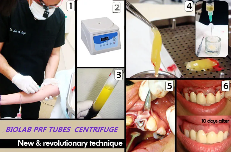 PRF DENTAL