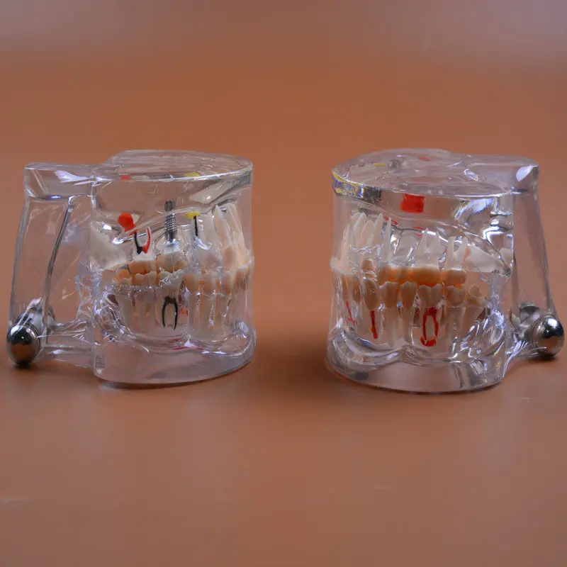 Modelo de Ensino de Odontologia Modelo de Patologia Dental com Implante Modelos de Dentes Modelos de Ensino Lote Odontologia Cuidados Orais Anatomia 2 Pçs - 3 Cheap Clareamento dos dentes