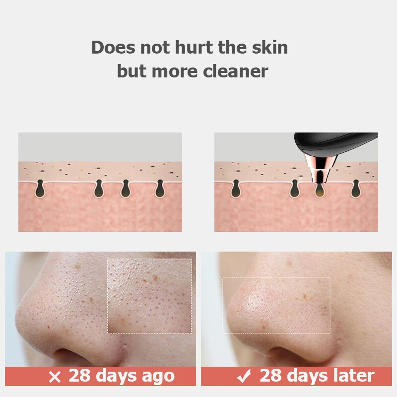 Limpeza dos Poros Sucção de Vácuo Removedor de Cravo Rosto Cravo Nariz Blackhead Remover Acne Pimple Ponto Preto Mais Limpo Vácuo 16 High Quality Beleza e saúde