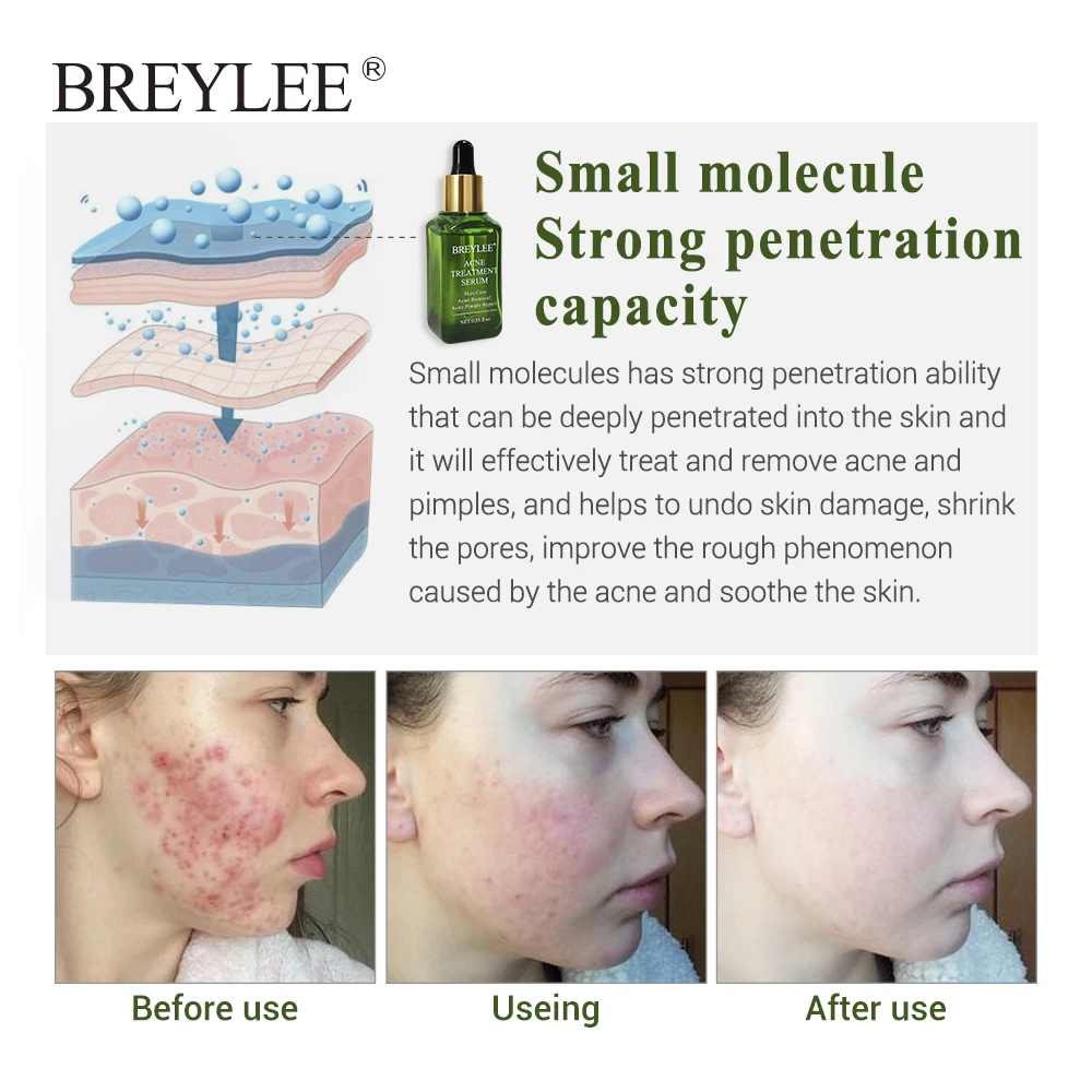 BREYLEE 2PCS Acne Treatment Serum Natural Facial Essence Acne Scar Removal Face Skin Care Whitening Repairing Pimples Remover